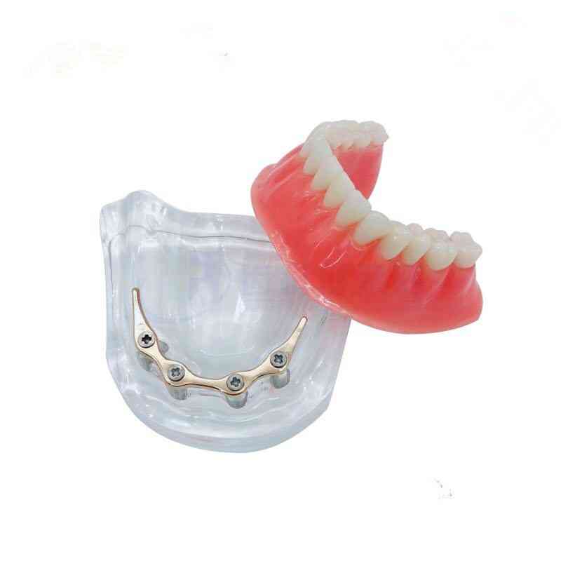Prothese tanden onderkaak model, overkappingsprothese implantaat model met gouden staaf tandheelkundig onderwijs model