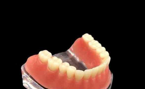 Modelo mandibular de dientes de dentadura postiza, modelo de implante de sobredentadura con modelo de enseñanza dental de barra dorada