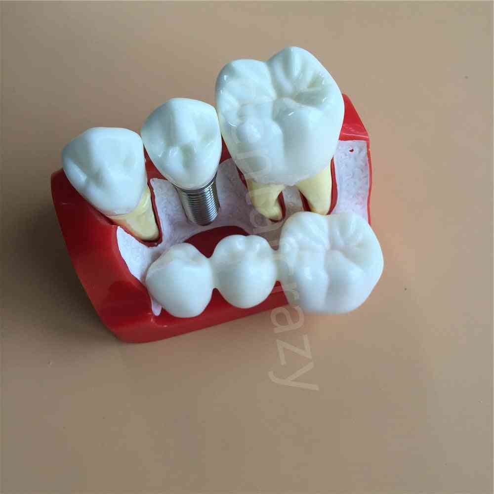Dentysta uczyć analizę implantu most koronowy zdejmowany model demonstracja dentystyczna model zębów -