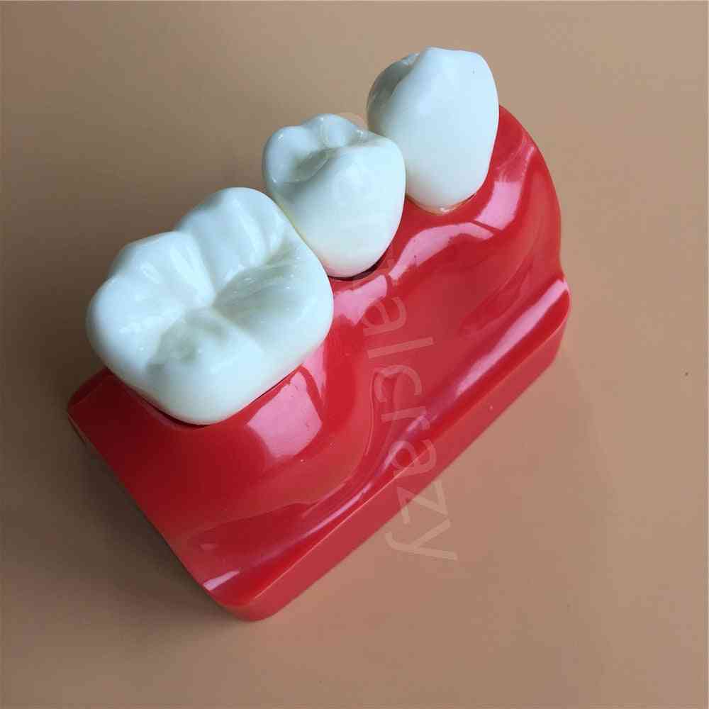 Dentysta uczyć analizę implantu most koronowy zdejmowany model demonstracja dentystyczna model zębów -