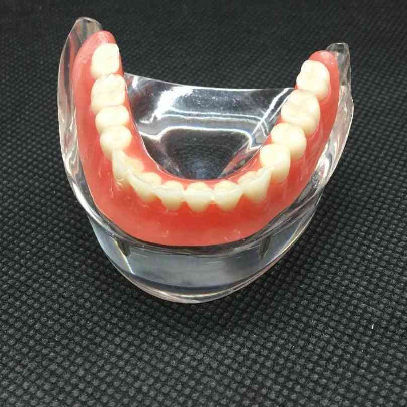модел на долночелюстни долни зъби със зъб за възстановяване на импланта