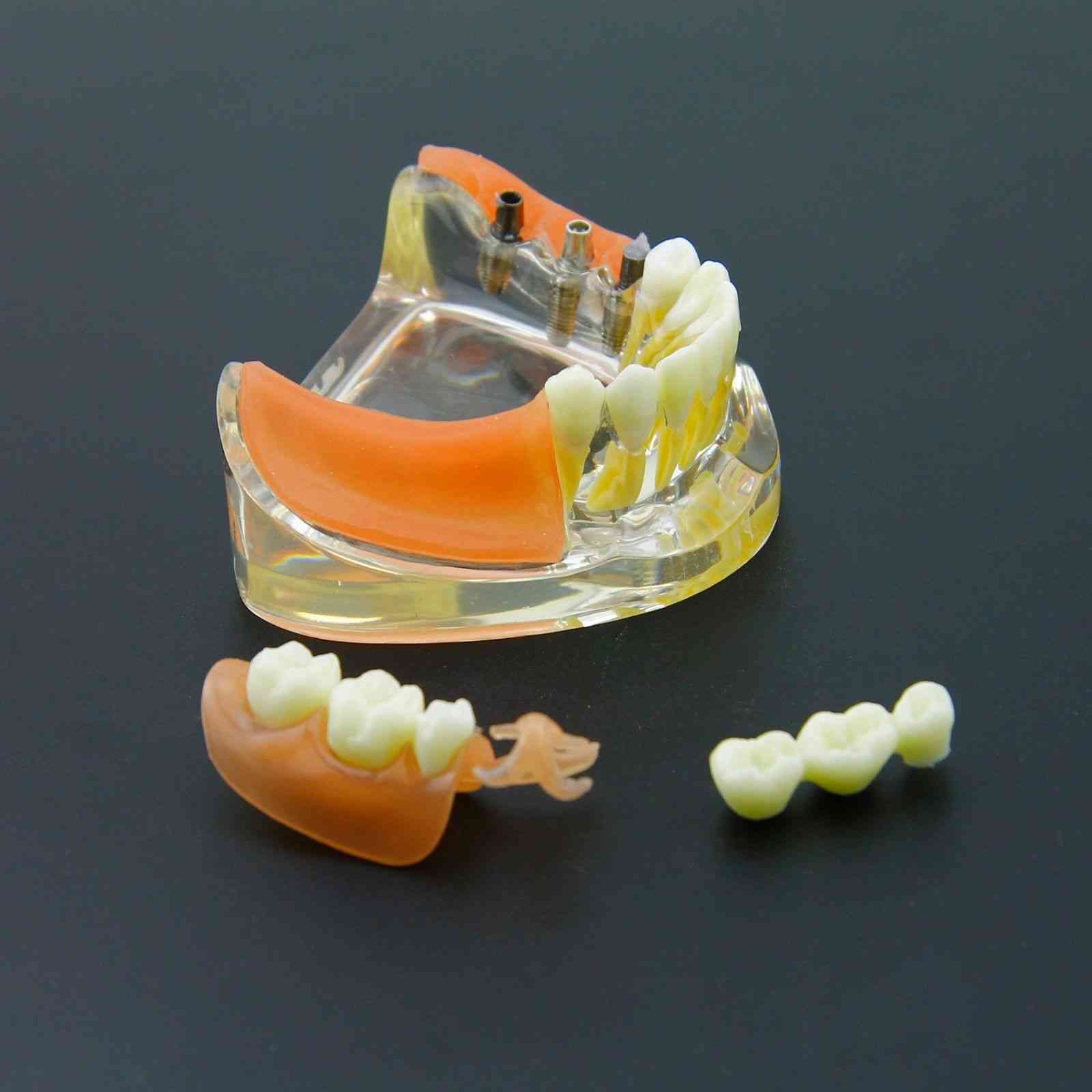 Zahnimplantat-Restaurationszähne Modell - Demo zur herausnehmbaren Brückenprothese