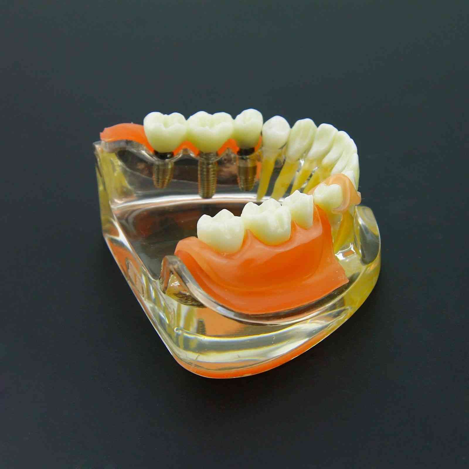Modelo de dientes de restauración de implantes dentales - demostración de prótesis de puente extraíble