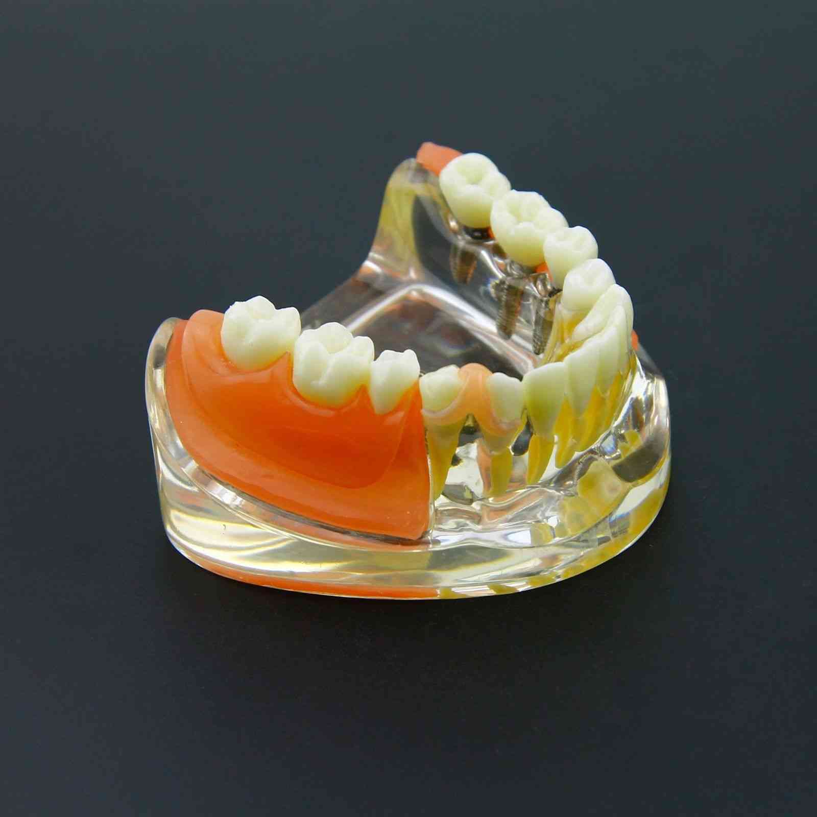 Dental Implant Restoration Teeth Model - Removable Bridge Denture Demo