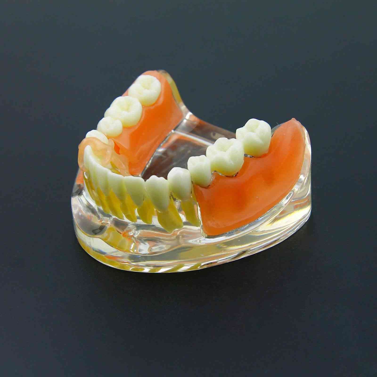 Modelo de dientes de restauración de implantes dentales - demostración de prótesis de puente extraíble