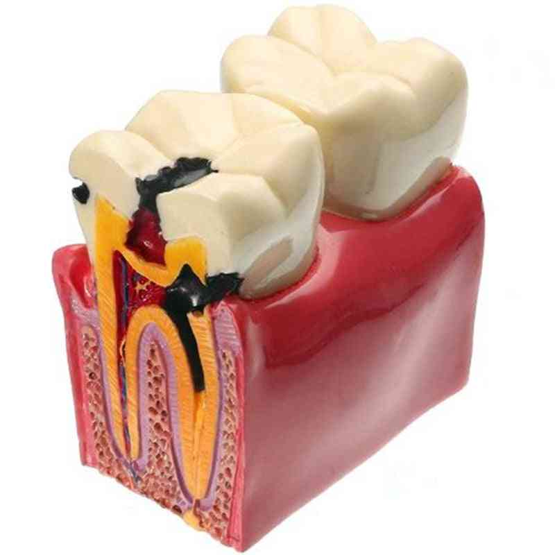 1pc Dental Materials Lab Teeth Model - 6 Times Caries Comparation Study For Dentist