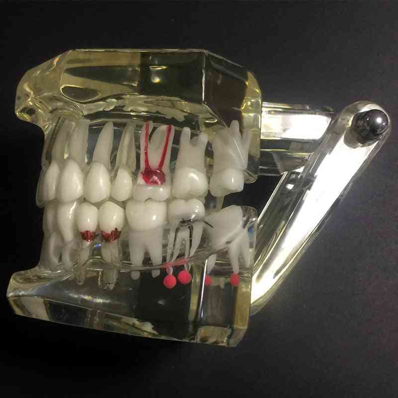 Dental Disease Teeth Implantation Model-detachable Design