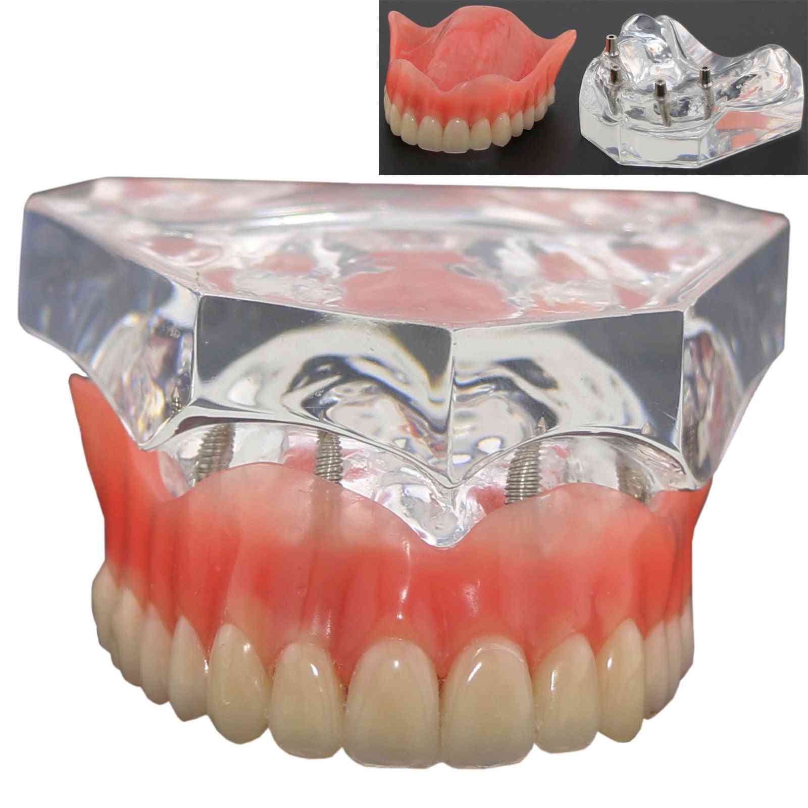 1 Stück Dental Upper Overdenture Superior 4 Implantate Demomodell, Zahnmodell