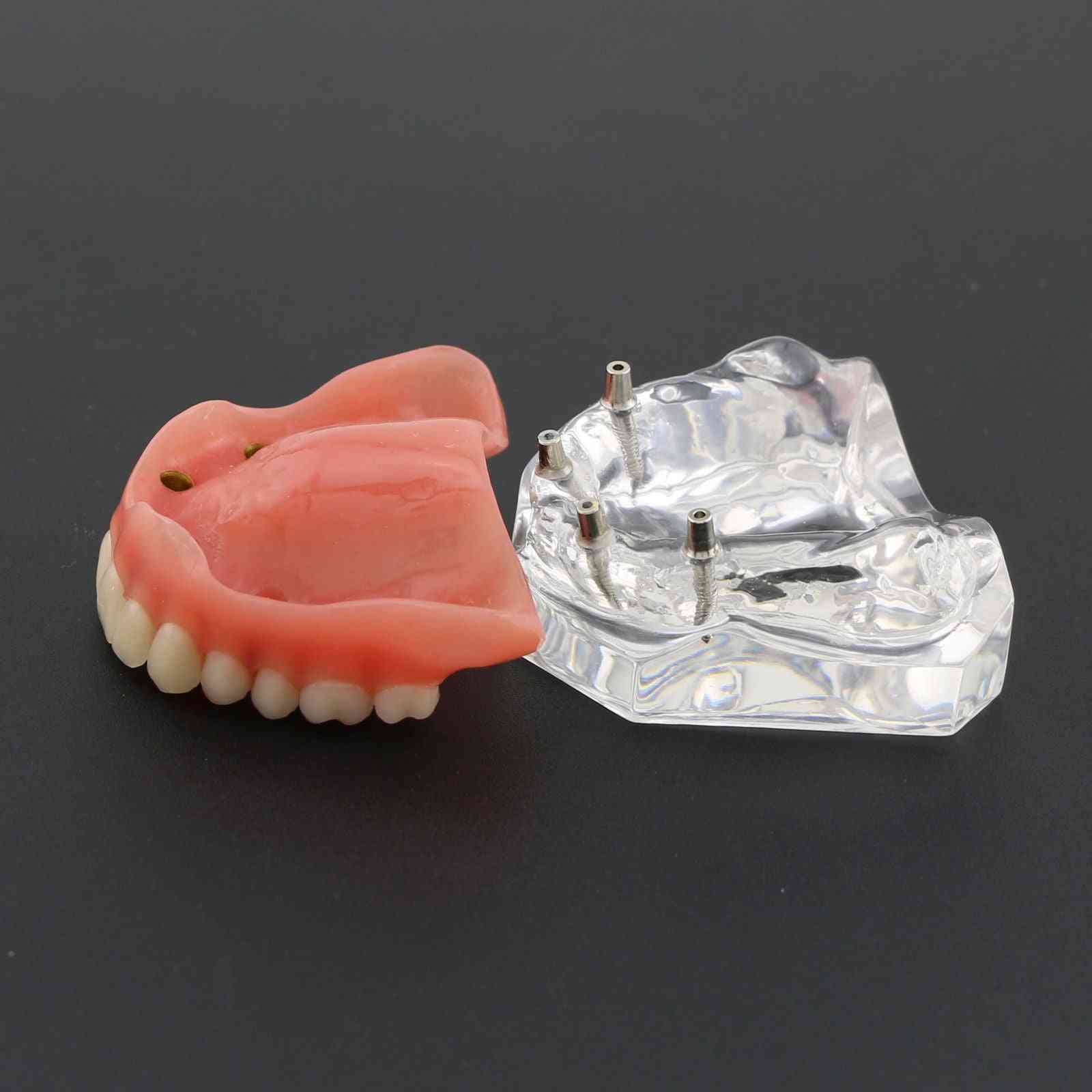 1 Stück Dental Upper Overdenture Superior 4 Implantate Demomodell, Zahnmodell