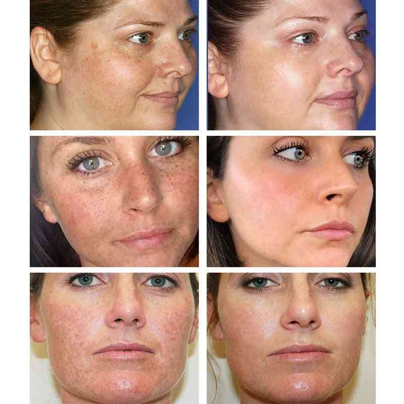 Whitening Facial Cream Repair Fade, Freckles, Remove Dark Spots