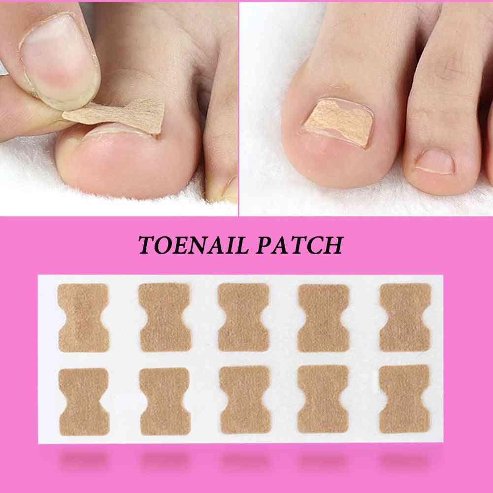Ingrown Toenail Corrector Sticker - Paronychia Treatment Fixer,  Recover , Corrector Pedicure Foot , Toe , Nail Care Tool