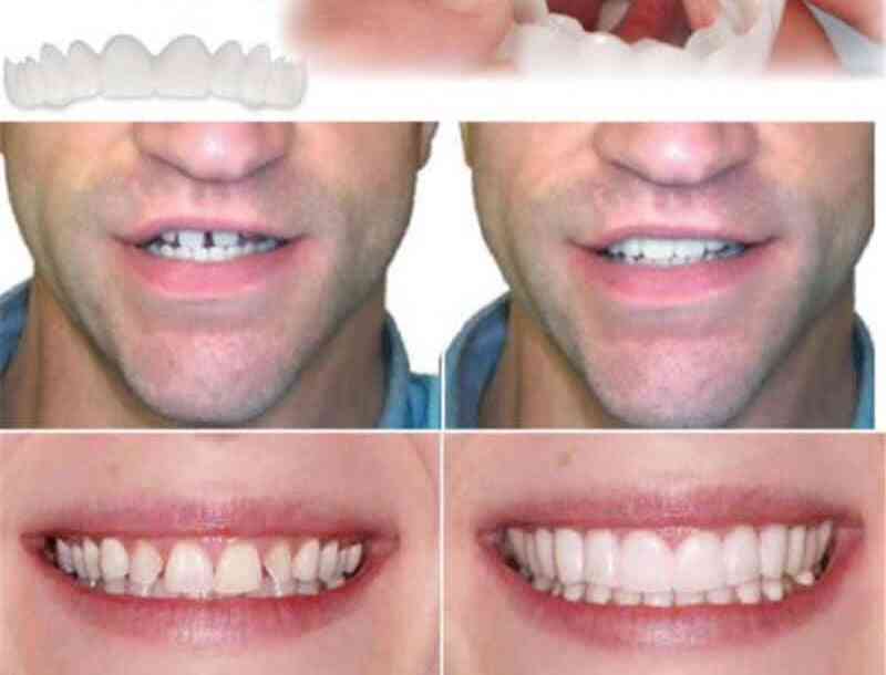 Ylemmät ja alemmat hampaat täydelliset hymyviilut mukavuus sovittaa joustavat hammasproteesiliittimet kaksinkertaiseen valkaisuriviin