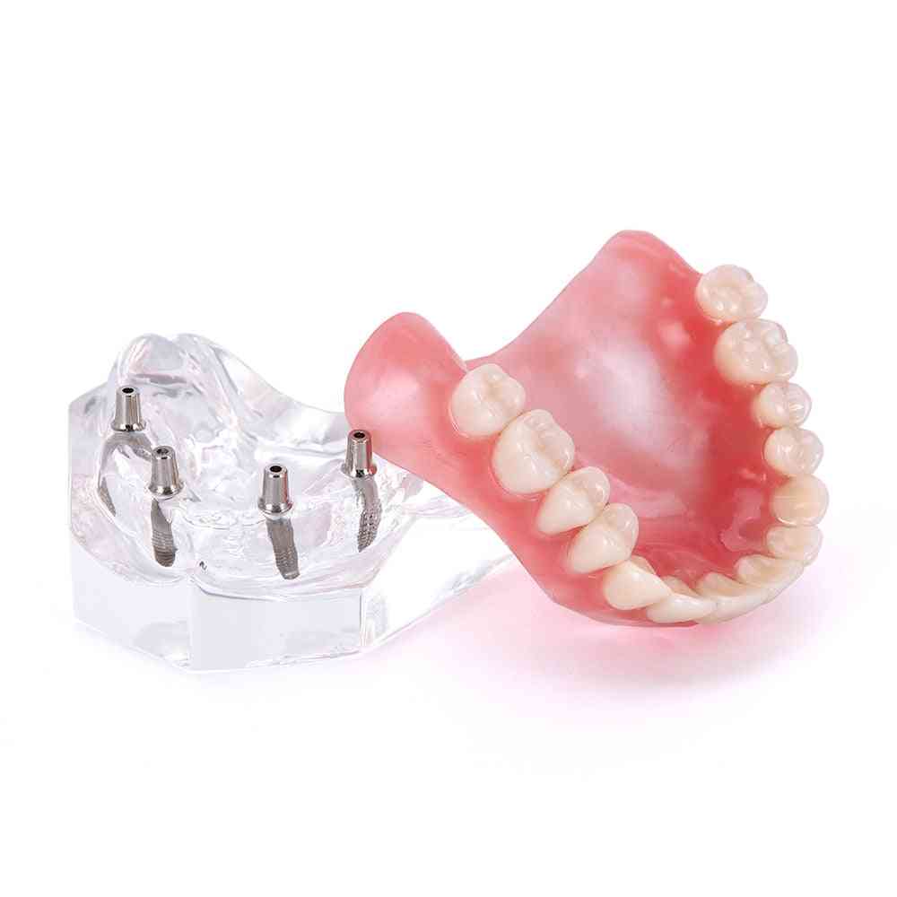 Zobni vsadki- odstranljiva notranjost z zgornjim in spodnjim zobom