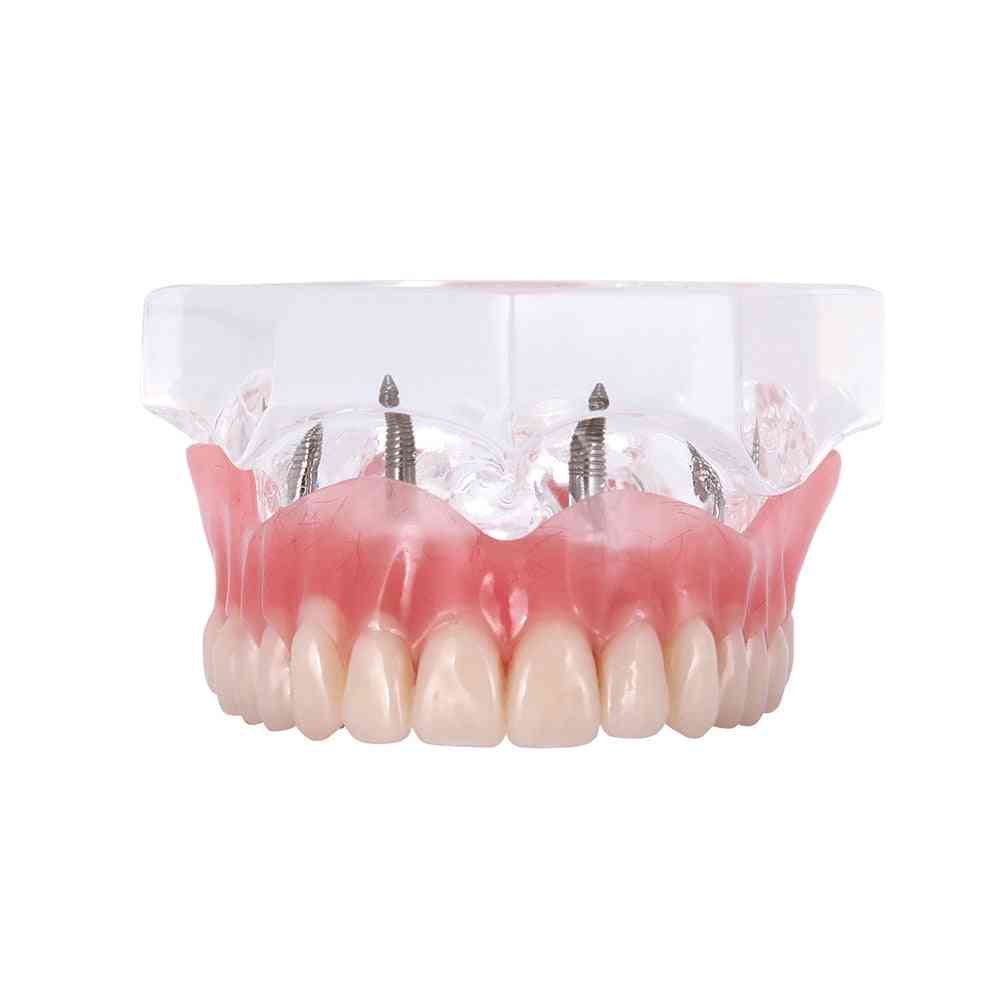 Zęby implantu dentystycznego - wyjmowane wnętrze z implantami górnym, dolnym nauczaniem zębów