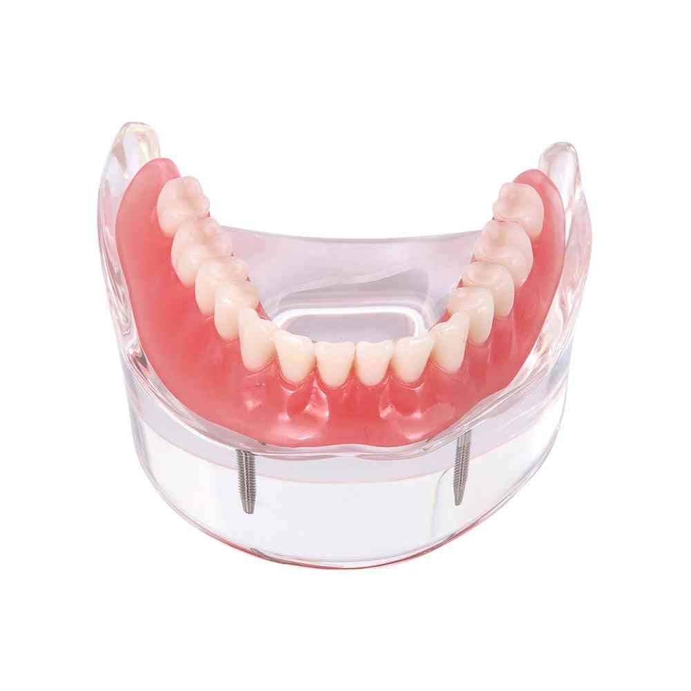 Zahnimplantatzähne - herausnehmbares Inneres mit Implantaten obere, untere Zahnlehre