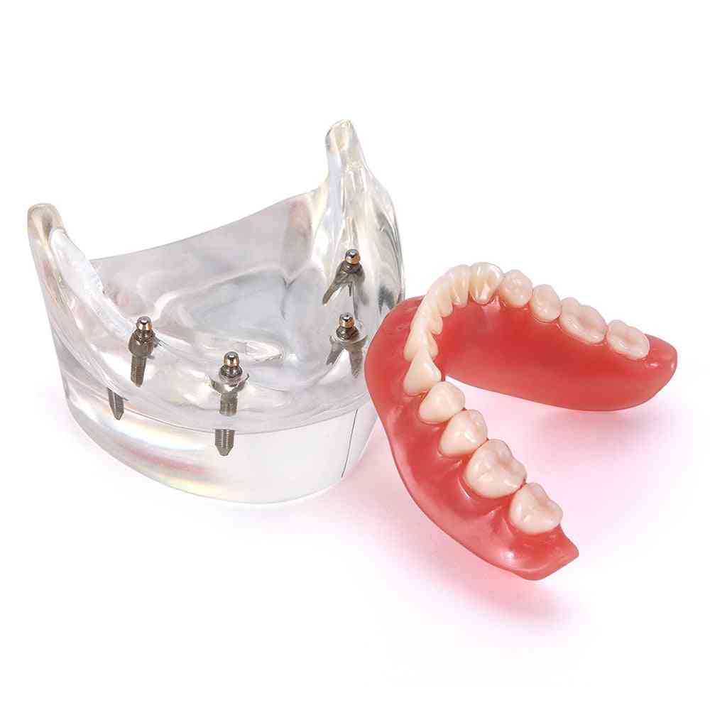 שיניים להשתלת שיניים - פנים הניתנים להסרה עם שתלים מלמדים שיניים עליונות ותחתונה