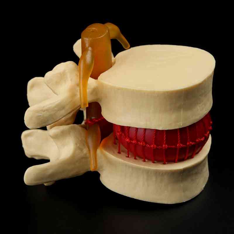 Medicinske rekvisitter model gratis porto anatomisk rygsøjlen lændehvirvelseskive