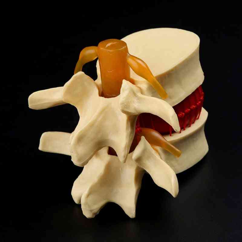 Medicinske rekvisitter model gratis porto anatomisk rygsøjlen lændehvirvelseskive