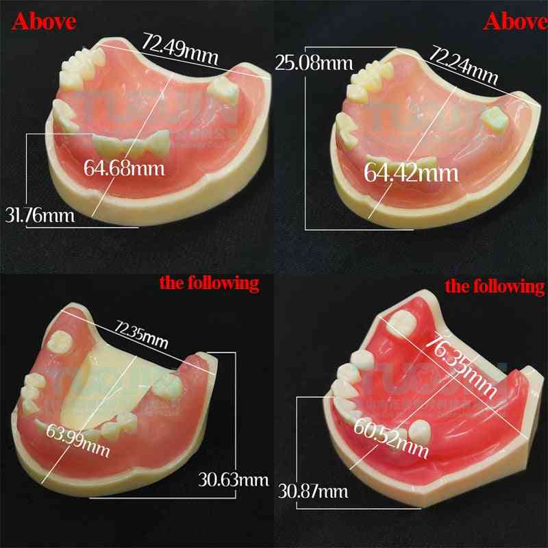 Tandimplantat typodont tandmodell - restaurering sjukdomsanalys demo studie tandmodell